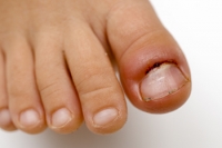 Managing a Toe Infection