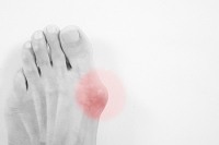 Shoes and Genetics Can Lead to Bunions Developing