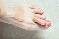 Definition and Reasons for Developing Hammertoe