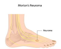 How to Find Relief With Morton’s Neuroma