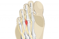 Symptoms and Causes of Morton’s Neuroma