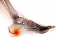 Can Relief Be Found From Heel Spurs?