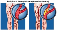 How Peripheral Artery Disease Affects the Feet