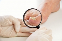 Causes of Fungal Nail Infections